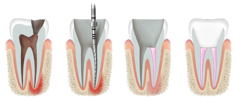 Root canal procedure can save your tooth