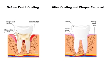 When is teeth scaling considered urgent?