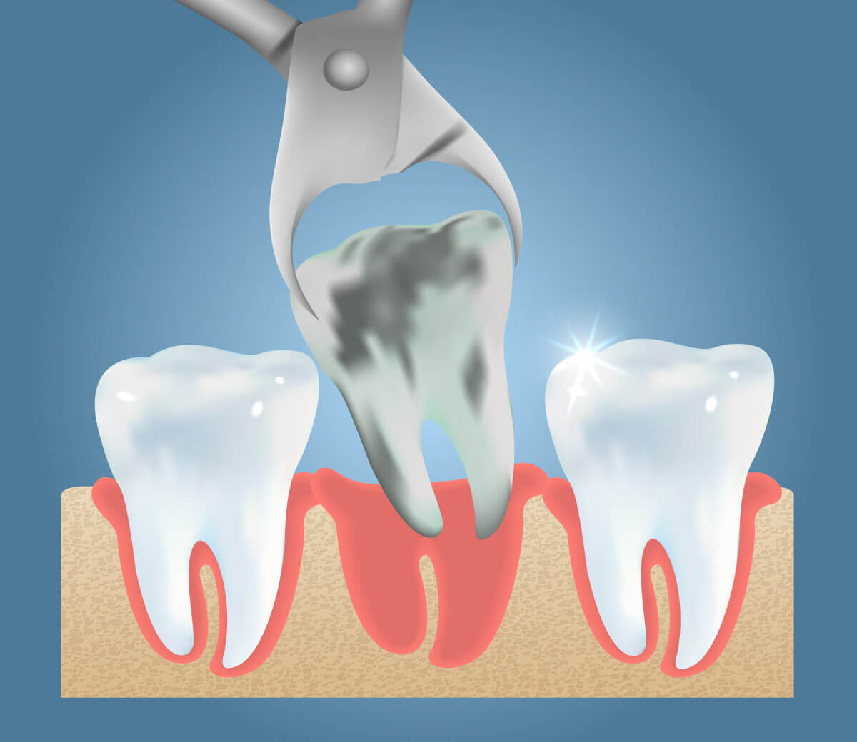 tooth-extraction