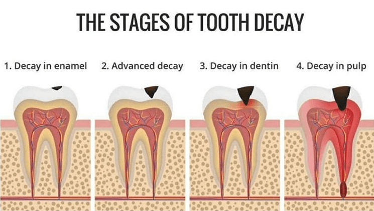 stages-of-tooth-decay