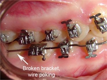 What to do when I have an orthodontic wire sticking out and poking the gums?