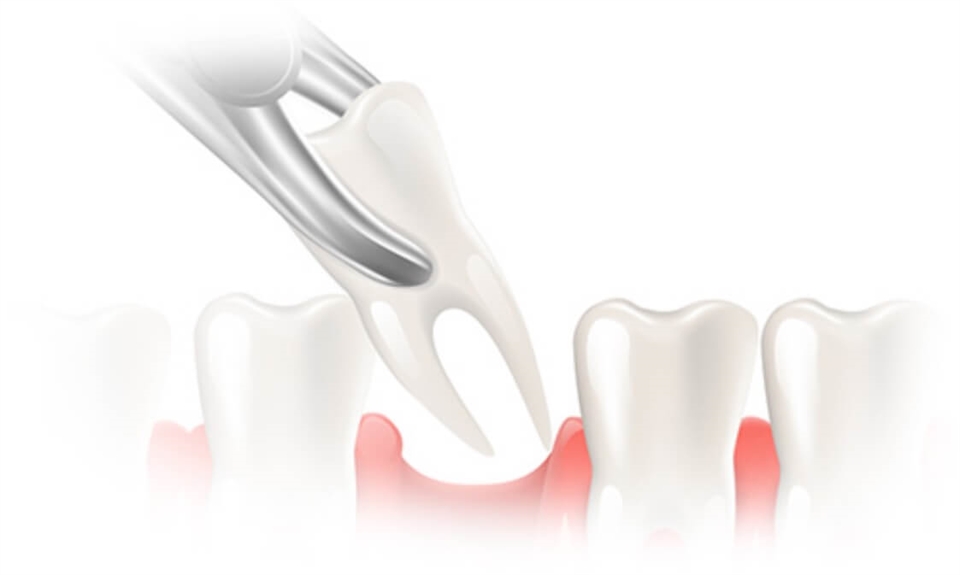 Dental extraction