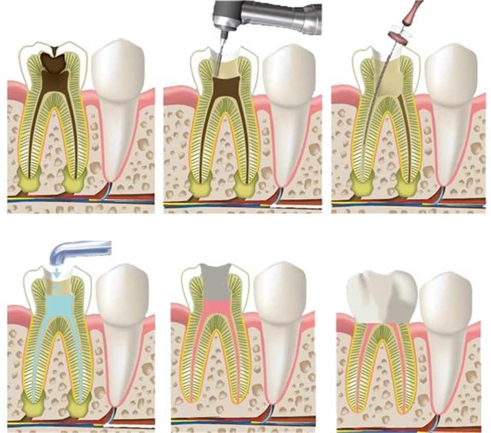 Endodontic treatment in central London