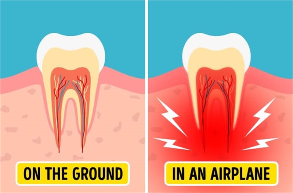 Barodontalgia - toothache when you fly or dive