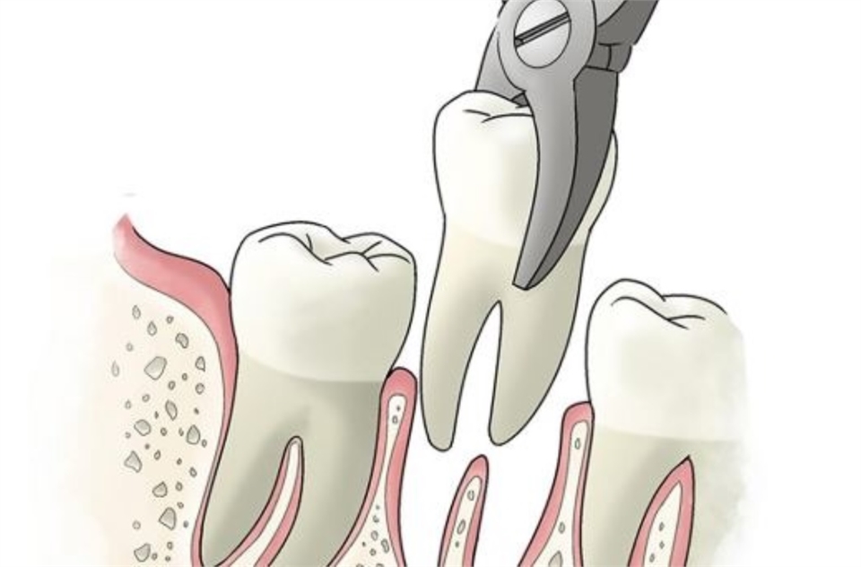 Bony spicule left after tooth extraction