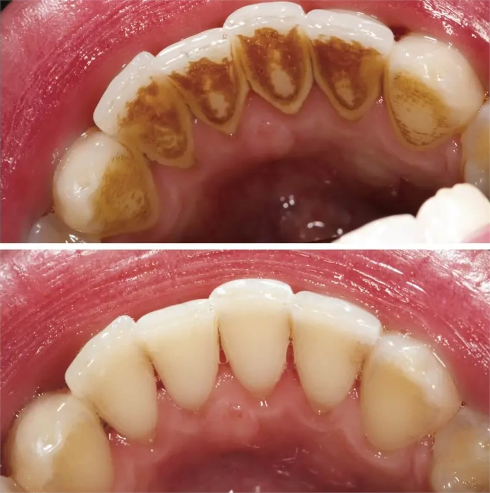 Teeth scaling procedure results before and after