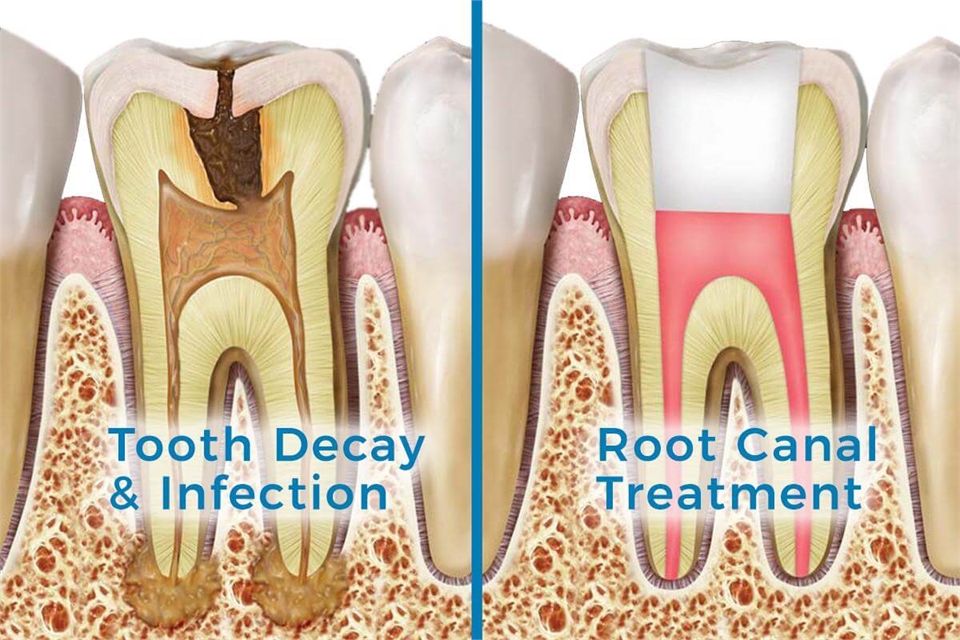 Root canal treatment by endodontic specialist