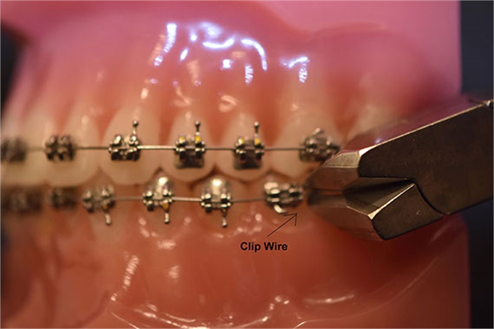 Cut the orthodontic wire which is poking and gums and sticking out