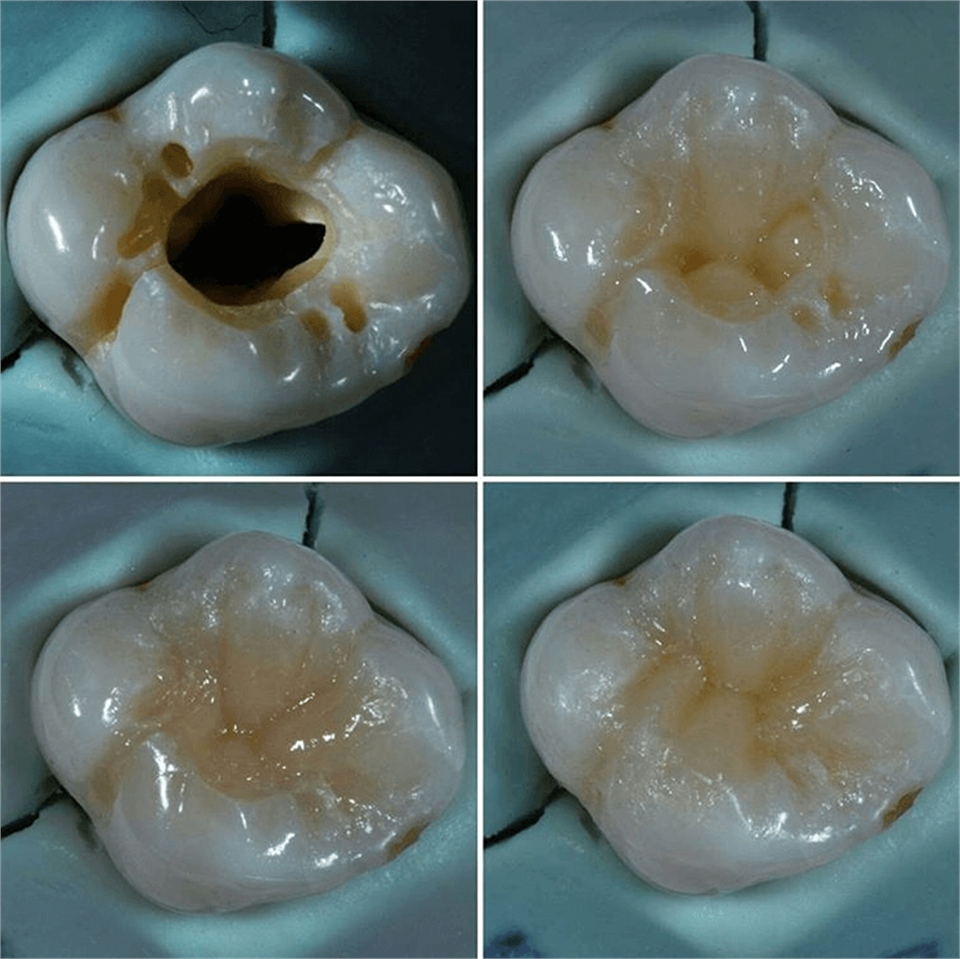 Tooth filling procedure and result