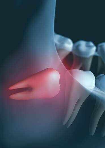 Wisdom Tooth Removal - Emergency Dentist London - Emergency Dentist London Wisdom Tooth Removal