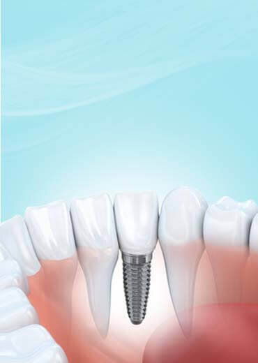 Lost Tooth - Emergency Dentist London - Emergency Dentist London Lost Tooth