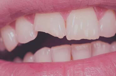 Broken Tooth - Emergency Dentist London - Emergency Dentist London Broken Tooth